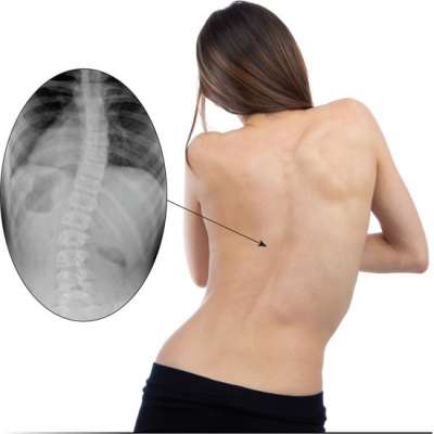 Scoliosis: What Every Parent should Know!
